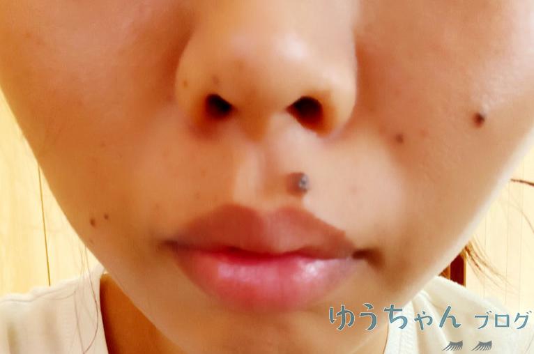 ほくろ除去前の写真