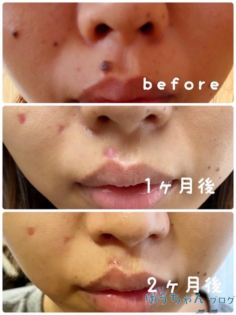 ほくろ除去前から2か月後