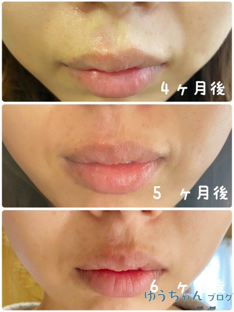 ほくろ除去切開縫合法術後