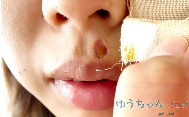 ほくろ除去あと3日目