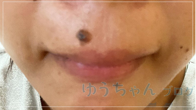 大きなほくろ